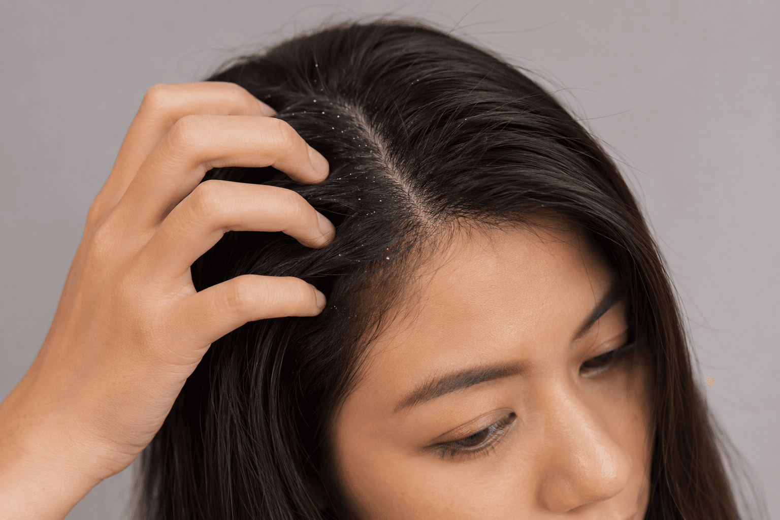 Hair With Dandruff